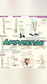 Levels Of Amputation in Upper Limb & Lower Limb #amputation #ampute #amputee #levelsofamputation