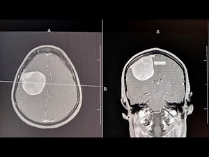 Brain Tumor Symptoms Described