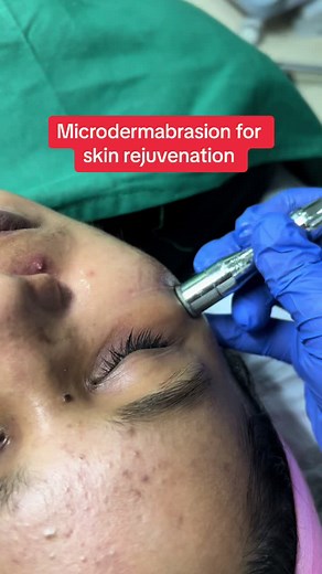 Microdermabrasion: Rejuvenate Your Skin Effectively