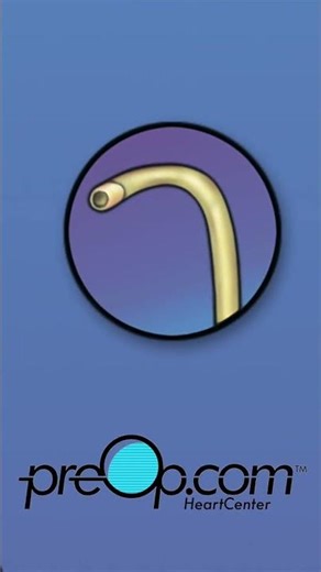 PreOp® Heart Stent (PCI) Patient Education | Cath Lab Flow, Risks, and Aftercare #shorts