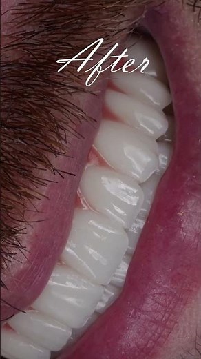 Xcell Dental Implants: Before & After Transformation