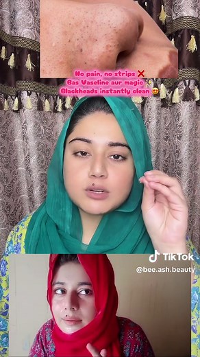 Blackheads Remove Remedy with Vaseline | Clean Pores Instantly