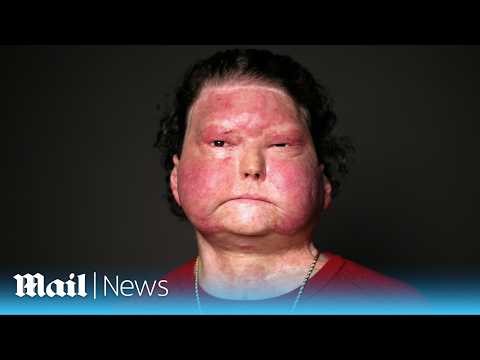 World’s first face & double hand transplant: The moment Joe DiMeo saw his new appearance