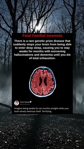 There is a rare genetic prion disease that suddenly stops your brain from being able to enter