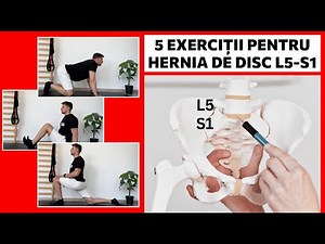 5 exerciții pentru hernia de disc L5-S1 | KINETOTERAPIE