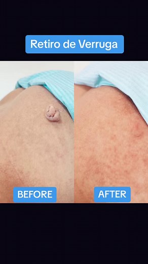 380K views · 1.1K reactions | Depilación Láser | Aquabella | Facebook