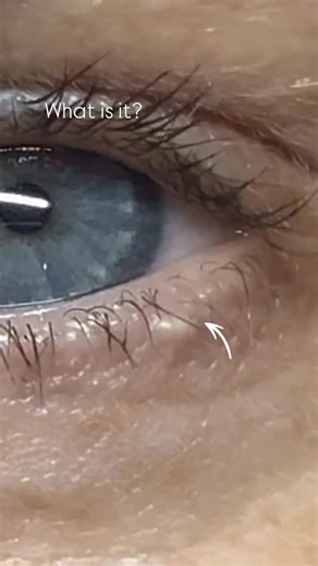 Liz Ellis | Skin Specialist & Educator on Instagram: "Milia explained 👇 That small white bump near the lash line is milia, caused by blocked sebum trapped beneath the skin. Because milia can be stubborn and difficult to remove — particularly around the eye — it should only be treated by professionals using the correct techniques. Before & after results speak for themselves ✨ DM for details or bookings #skincare #milia #miliaremoval #skinknowledge"