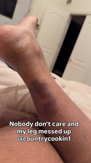 Last week at the coat and boot drive a table fell on me. I kept saying my leg hurt so bad, but my dumb self never looked at the back of my leg. Now yungbuck wanna sleep instead of helping my leg🙄 | CountryCookin1