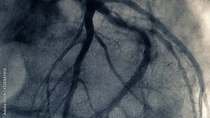 Catheterization. Cardiac ventriculography is a medical imaging test used to determine a patient cardiac function in the right or left ventricle