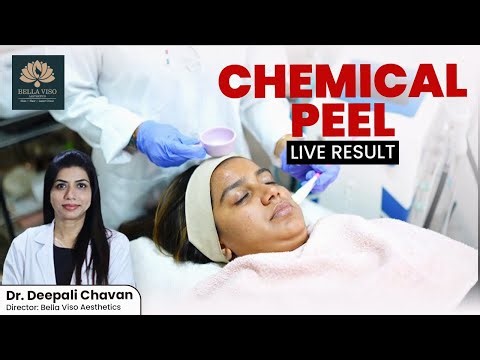 Live Chemical Peel Treatment | Step-by-Step Chemical Peel for Glowing Skin | Dr. Deepali chavan
