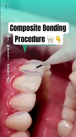 COMPOSITE BONDING Procedures transfer your SMILE in Only One visit