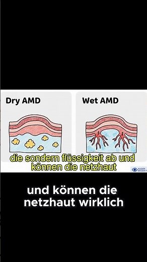 Trocken vs. Feucht: Welche AMD ist gefährlicher? 👁️ #Augenwissen #AMD #Gesundheit #Medizin #Wissen
