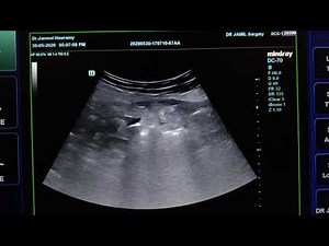 Appendicular Abscess/phlegmon
