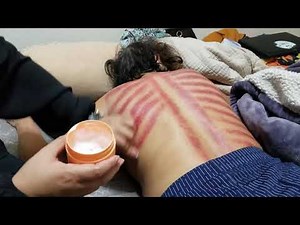 Coining, Cambodian Remedy for sickness