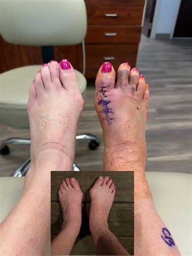 7 days post op-Bunion correction and joint fusion #surgery #bunioncorrector #bunions #bunionrelief