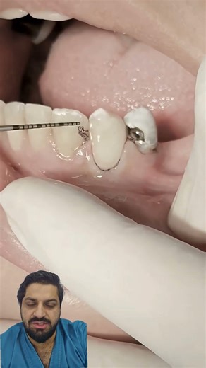 class 5 filling-ASMR #dentist #dentalclinic #dentalprosthesis