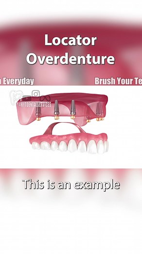 Understanding Overdentures and Their Benefits