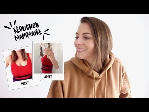 BREAST REDUCTION - WHY? PRICE? MY BEFORE/AFTER EXPERIENCE: I'LL TELL YOU EVERYTHING!