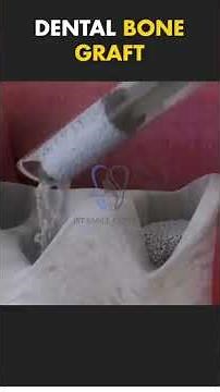 Bone Graft Procedure Explained: Restoring Smiles with Precision!