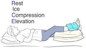 Step-by-Step: Using RICE | Saint Luke's Health System