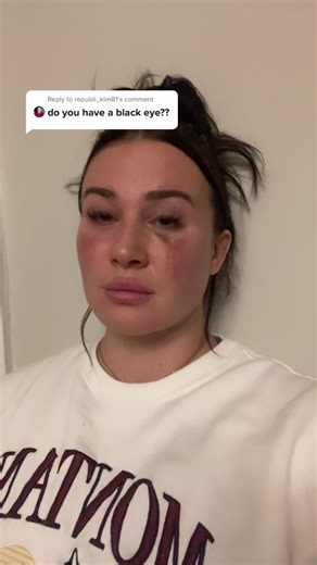 Reply to @republi_kim81 the black eye origin story