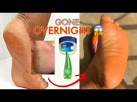 How to get rid of dead skin from your feet at home OVERNIGHT | no dry and cracked heels