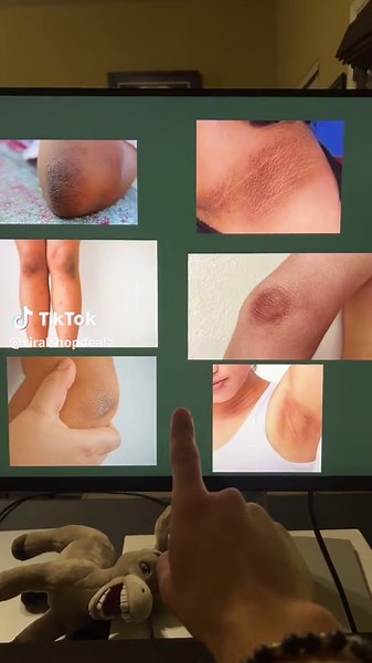 Eliminate Dark Spots with Lemon Turmeric Soap