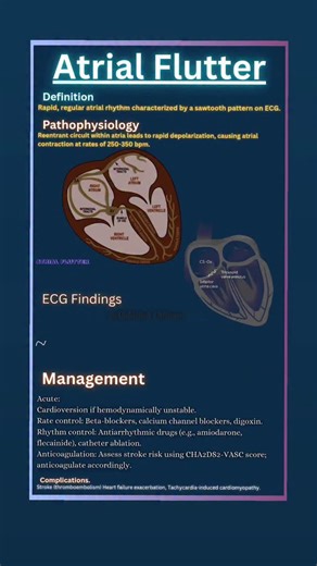 Abdallah Othman on Instagram: "🔵 Atrial Flutter: Fast, Regular, and Recognizable! 🌀 What is it? A rapid, regular atrial rhythm with classic sawtooth waves on ECG. ⚡ Why it matters: Caused by a reentrant circuit—leads to atrial rates of 250–350 bpm and risk of stroke. 💡 Management Highlights: Acute: Cardioversion if unstable Rate control: Beta-blockers, CCBs, digoxin Rhythm control: Antiarrhythmics, ablation Stroke prevention: Anticoagulate per CHA2DS2-VASc ❗ Complications: Stroke, heart failu
