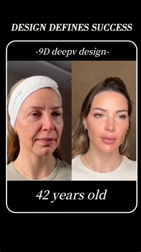 Drgang91 on Instagram: "9Dfacelift focuses on precise anatomical layers, optimizing superficial fat and SMAS support. A minimal adjustment enhances contours, softens expression, and restores a balanced, youthful look.#9Dfacelift #FacialContouring #MedicalAesthetics #BeforeAfter #面部提升 面部年轻化"