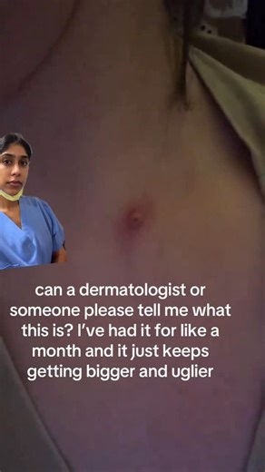 Dr. Neera Nathan on Instagram: "this is not a blackhead or cyst 🎥 faithjordynbeasley @dermskinhealth #cyst #blackhead #dermatologist #skincancer"