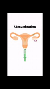 IUI: The Shortcut to Baby-Making! 🍼💖" 🚀 Struggling to conceive? Don’t worry, science has a little boost for you—Intrauterine Insemination (IUI)! Here’s the breakdown: 👩‍⚕️ How It Works? Think of it as a VIP pass for the best sperm! 🎟️ We take the healthiest, most active swimmers 🏊‍♂️, wash and prepare them, then place them directly into the uterus—right when you’re ovulating! Boom! Higher chances of fertilization! 🎯 💡 Who Should Try IUI? ✔️ Unexplained infertility 🤷‍♀️ ✔️ Low sperm coun