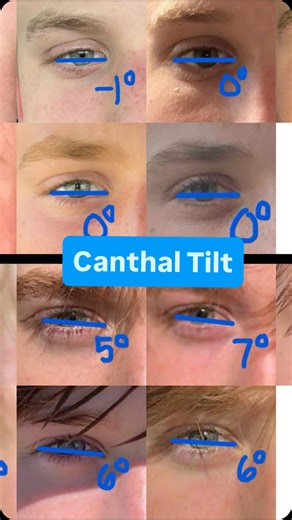 Jordan Wood on Instagram: "My Canthal Tilt Progression (Part 1), full video on youtube #eye #beauty #canthaltilt #looksmax #information"