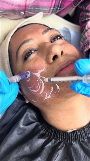 #bbglowtreatment #scar revision #http://drsonalshahcosmeticaindia.com/#acnescars