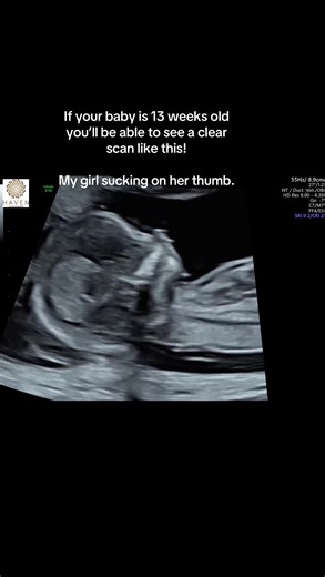 13 Weeks Pregnant: Clear Baby Scan and Development