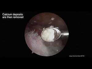 Arthroscopic removal calcific tendonitis