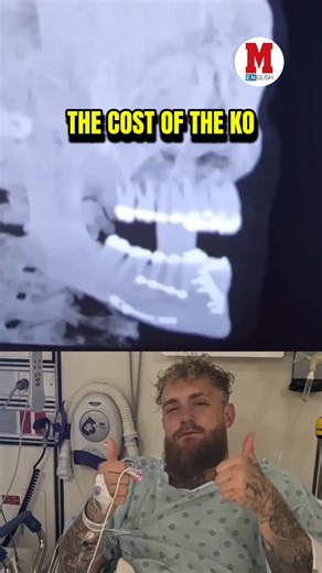 Jake Paul confirms jaw surgery after the Joshua KO. Teeth removed. Titanium plates added. 😳 #Boxing #JakePaul #AnthonyJoshua | Marca in English