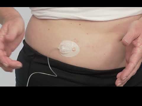 Pompe à insuline t:slim X2 : Comment utiliser le set de perfusion VariSoft ?