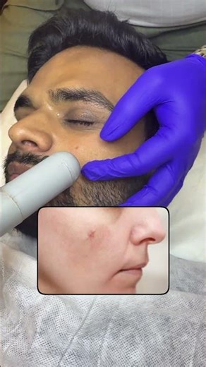 Mole Removal in 1 Visit 😳 Instant Results | Dr Kasana’s Clinic #skincare #moleremoval