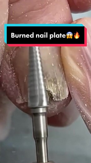 The nail plate got burned😱🔥 #nail #nails #manicure #pedicure #ingrown #ingrowntoenail #ingrownhairremoval