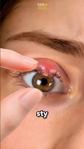 Never pop a stye on your eye ⁉️😱 #stye #medical #health