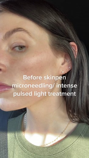 Lumecca IPL and SkinPen Microneedling Treatment Journey