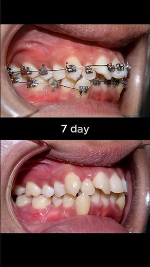 Evolution Of Braces 30 months #braces #orthodontist #dentist #dental