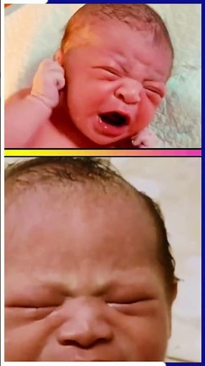 🥲Do Down Syndrome Babies Cry at Birth? #shorts