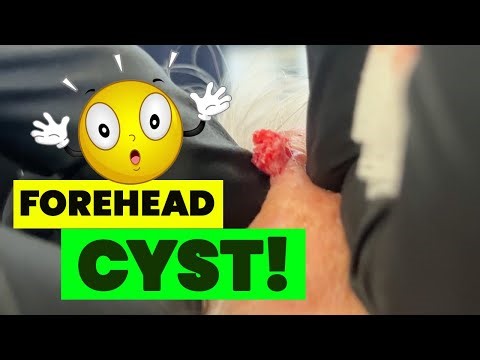 FOREHEAD CYST!