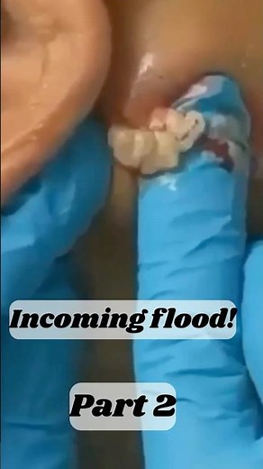 Cyst Explosion Caught on Camera! (part 2)