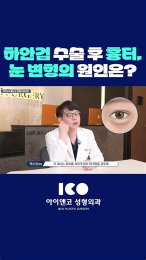 하안검 수술 후 흉터, 눈 변형의 원인은? #하안검 #눈밑지방 #눈성형 #성형외과 #shorts
