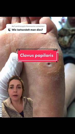 Effective Ways to Remove Corns and Calluses on Feet