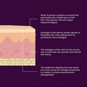 Human skin is composed of three main layers: the outermost called the epidermis, the mid layer called the dermis and the innermost layer named hypodermis or subcutis. The dermis and epidermis play big roles in scar formation as they facilitate the natural process of wound repair. | Mederma
