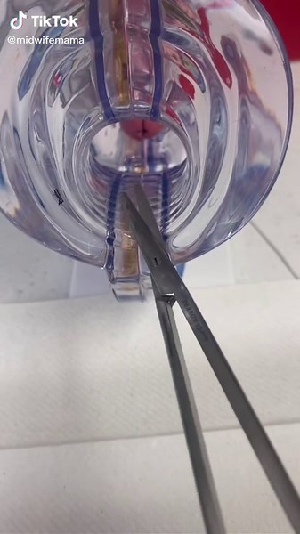 IUD String Trimming and Maintenance Tips