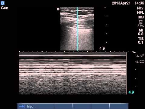 ultrasound diagnosis of pneumothorax